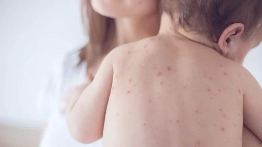 ABD’de kızamık salgını 12 eyalete yayıldı – BRTK