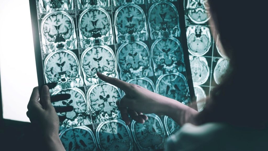 Beynine çip takılan ALS hastası, şarkı söylemeye başladı – Son Dakika Teknoloji Haberleri