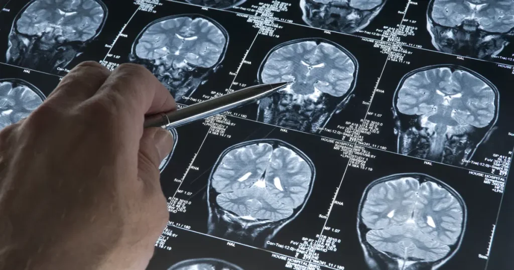 Alzheimer’da gençlik proteini keşfi | NTV Haber