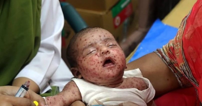 Bangladeş’te kızamık salgını: Ölen çocuk sayısı 1201’e çıktı – Kıbrıs Gazetesi